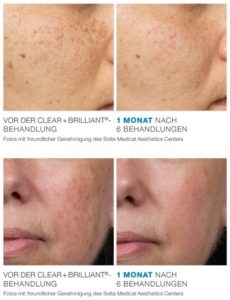 Clear & Brilliant Haut Effekte