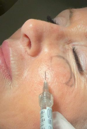 Hyaluronsäurebehandlung